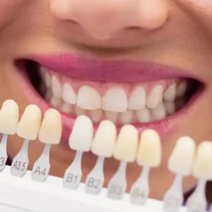 Zirconia Veneer Laminated