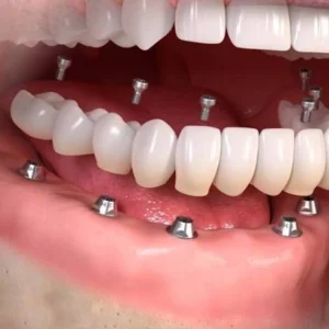 Zirconia Implant Laminated Screw Retained (Parts Included)