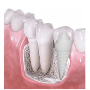 Zirconia Implant Monolithic Premium (Parts Included)