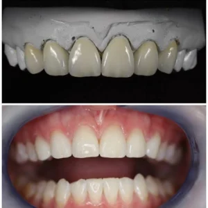 IPS e.max Press Crown & Bridge Laminated