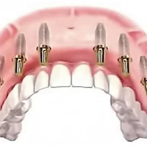 Add Gingival Ceramic Porcelain p/u