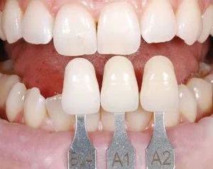 IPS e.max Press Onlay & Inlay Monolithic Premium