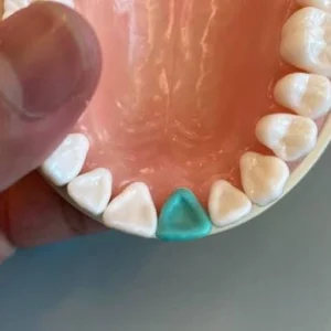 Handcrafted Wax-up p/u