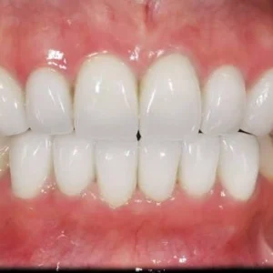 Zirconia Veneer Monolithic Premium