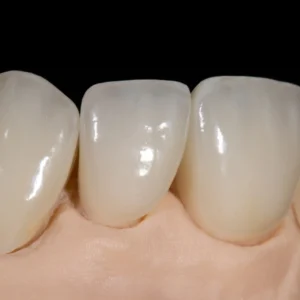 Full Arch Zirconia on 4 Implants (Parts Included)