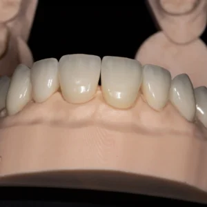 Feldspathic Refractory Veneers