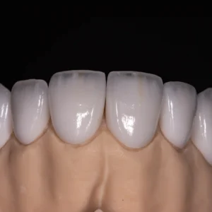 IPS e.max Press Veneer Laminated
